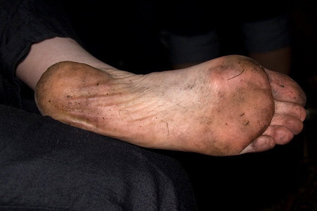 A post-firewalk foot 
